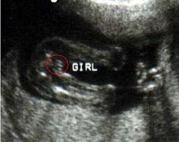 怀孕2个月怀男孩胎囊B超大揭秘，数据两大一小可能生儿子