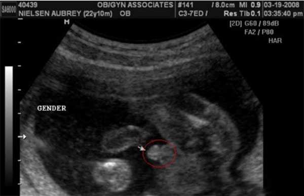 怀孕2个月怀男孩胎囊B超大揭秘，数据两大一小可能生儿子